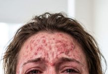 “Why is my face burning?” I screamed as angry red blisters spread across my skin. My boyfriend didn’t rush to help—he smirked. “No one will ever look at you again. You’ll be too ashamed to leave me.” My heart shattered harder than my mirror when I discovered he’d secretly poured corrosive chemicals into my skincare products. But he had no idea I’d just uncovered a truth that would destroy his life instead…